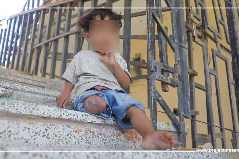 جنيف.. معرض يكشف صور لضحايا الألغام الحوثية